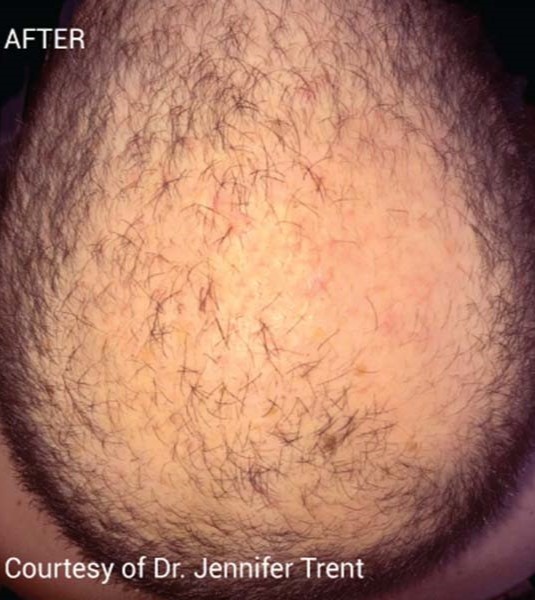 After Image: PRF Hair Restoration - front