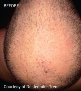 Before Image: PRF Hair Restoration