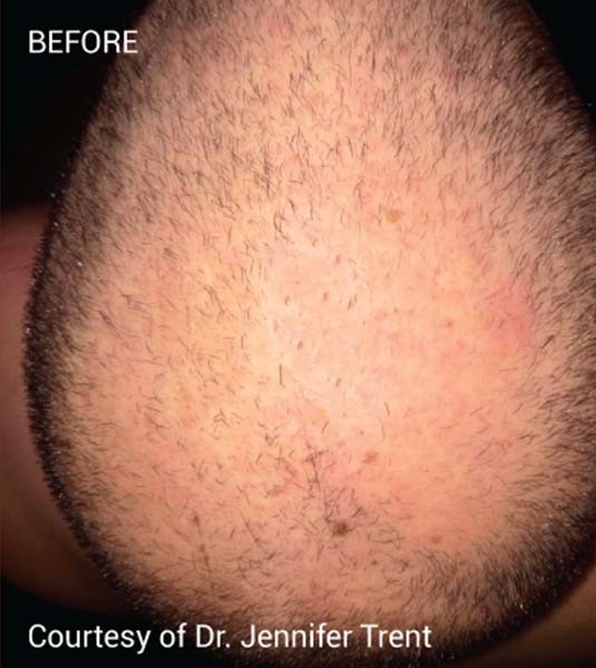 Before Image: PRF Hair Restoration - front